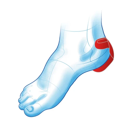 heel-protector-zastosowanie-kopia1.webp